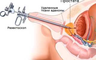 Трансуретральная резекция аденомы простаты (тур): что нужно знать?