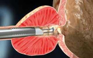 Лазерная вапоризация аденомы простаты