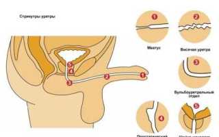 Бужирование уретры у мужчин: процедура и цены