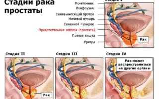 Рак предстательной железы 4 степени: продолжительность жизни и лечение