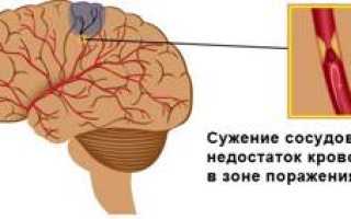 Чем опасен лакунарный инсульт головного мозга и как его пережить?