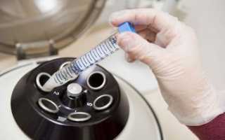 Микроскопическое исследование спермы: проведение и расшифровка