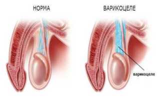 Варикоцеле ‒ что это такое и чем опасно заболевание