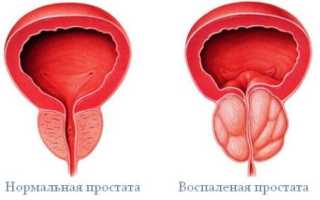 Хронический простатит: лечение, причины, симптомы и формы