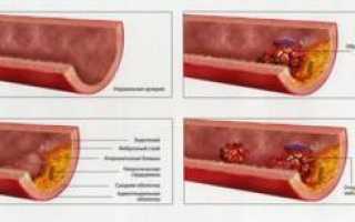 Атеросклероз – препараты,средства,таблетки и лекарственные средства для лечения сосудов