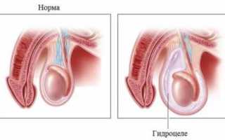 Водянка яичек у новорожденных мальчиков: причины, симптомы, диагностика и лечение