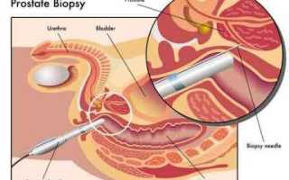 Биопсия простаты: проведение, осложнения и цены