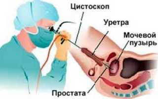Цистоскопия мочевого пузыря у мужчин: показания, подготовка и проведение