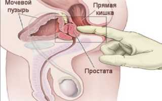 Массаж предстательной железы в домашних условиях