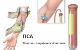 Анализ ПСА: норма, расшифровка по возрасту и отклонения (таблица)