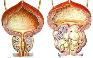 Операция при аденоме простаты и ее последствия
