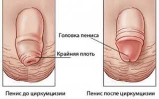 Обрезание у мальчиков: зачем его делают и как ухаживать после операции