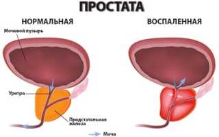 Профилактика простатита у мужчин: упражнения и другие методы