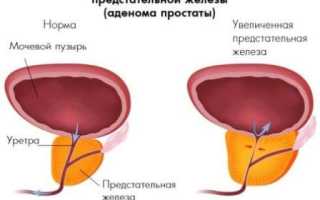 Гиперплазия простаты: причины, симптомы и лечение болезни