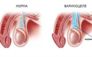 Лечение варикоцеле без операции: эффективные методы