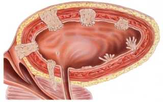 Опухоль мочевого пузыря у мужчин: причины, симптомы и лечение