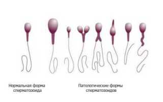 Морфология сперматозоидов: нарушения и улучшение показателей